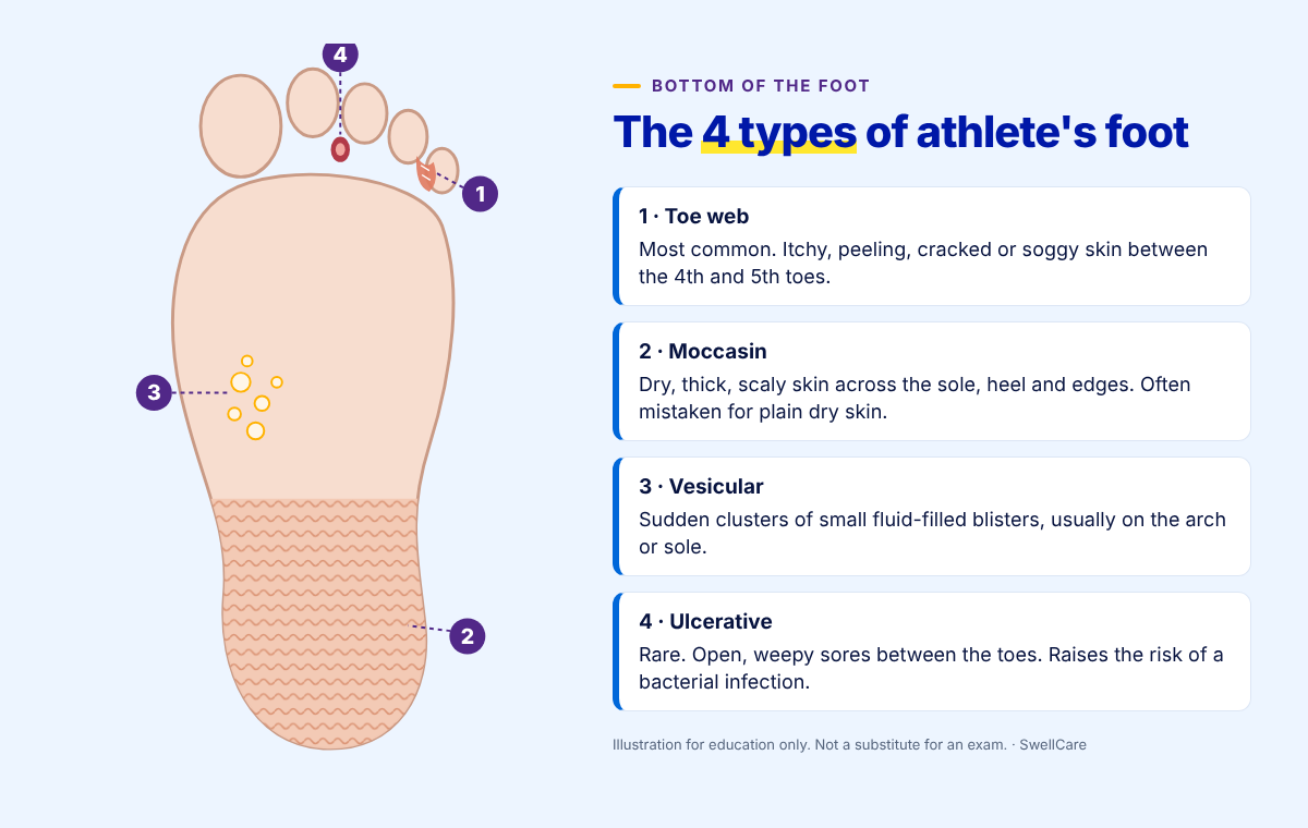 What Is Athlete’s Foot? Signs, Causes and Fast Relief