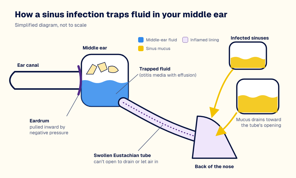 Diagram showing how a swollen Eustachian tube from a sinus infection traps fluid in the middle ear