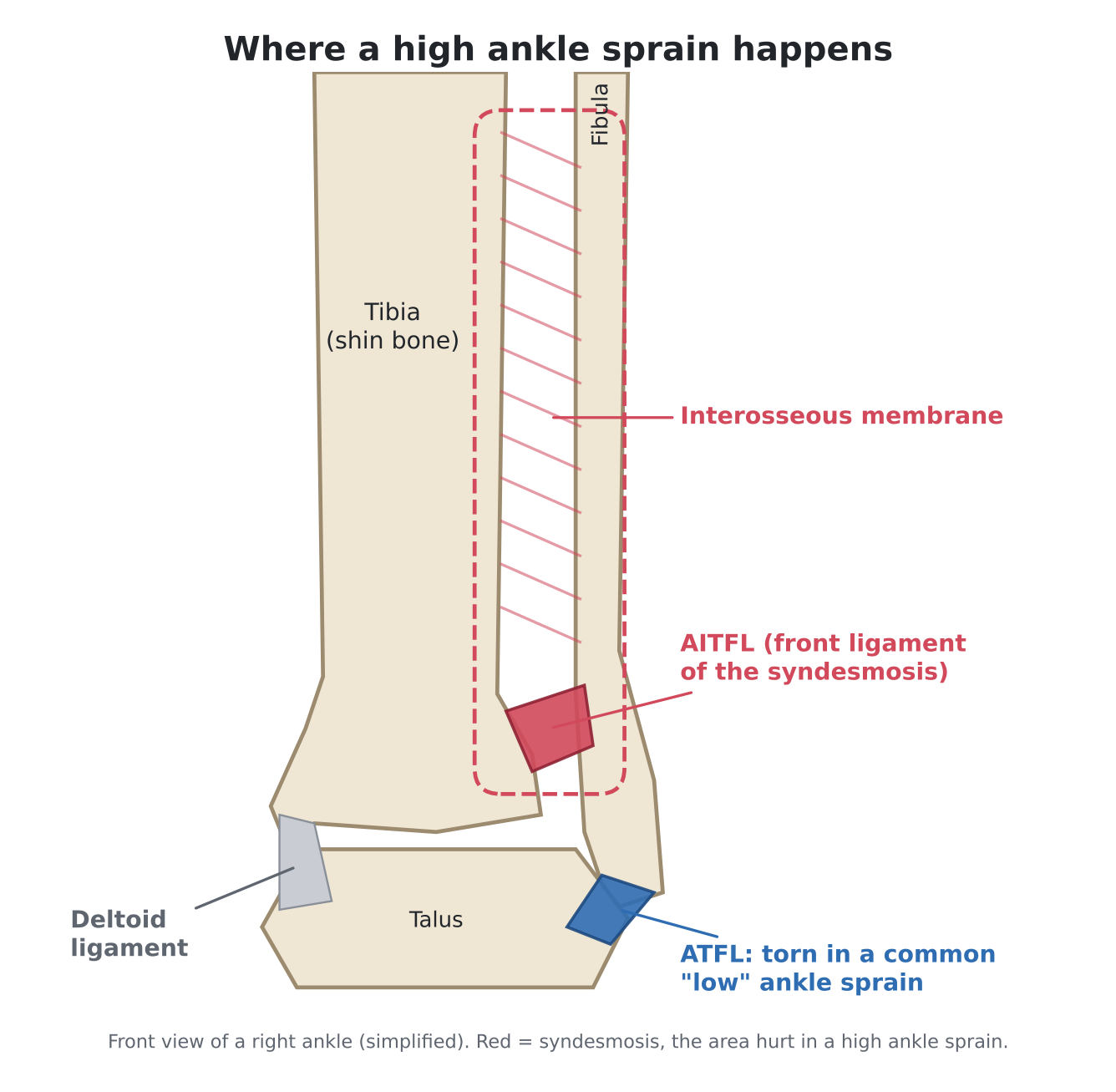 What Is a High Ankle Sprain? Symptoms, Recovery Time and When to Worry