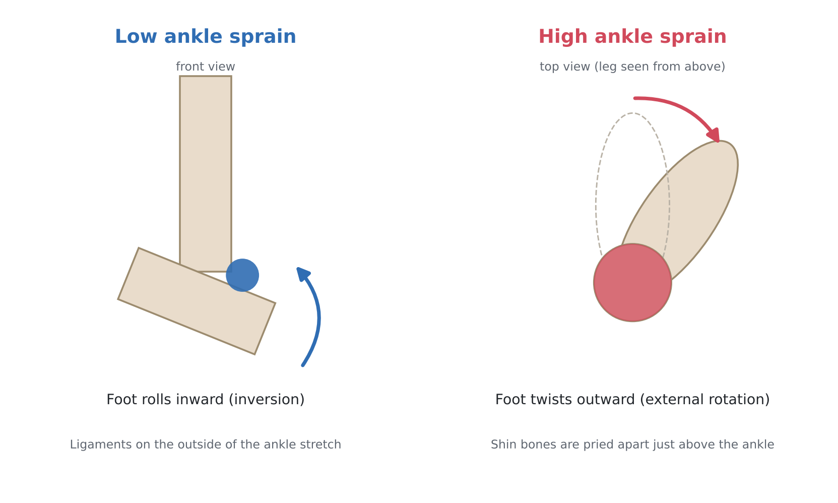 Side-by-side illustration: a low ankle sprain where the foot rolls inward, and a high ankle sprain where the foot twists outward and pries the shin bones apart above the ankle