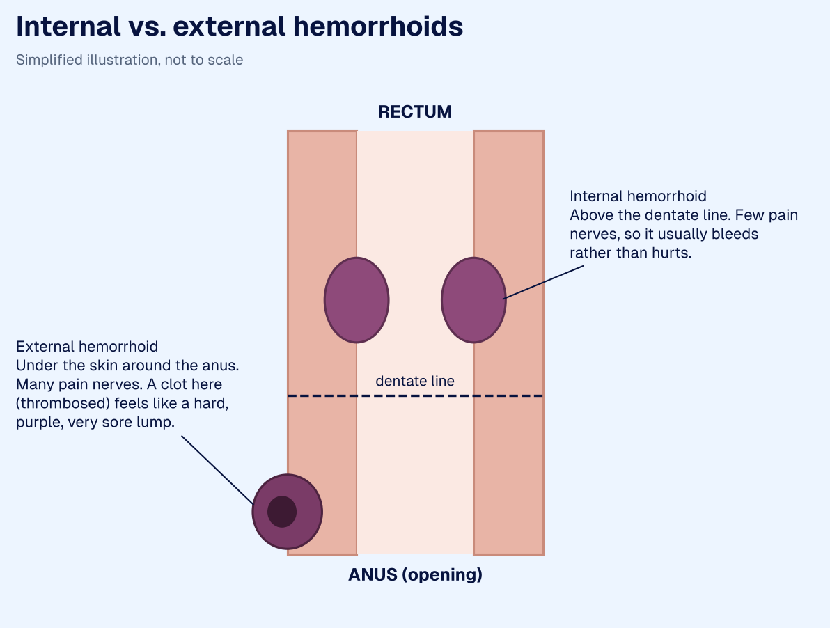Simplified diagram of internal hemorrhoids above the dentate line inside the rectum and an external hemorrhoid under the skin around the anus