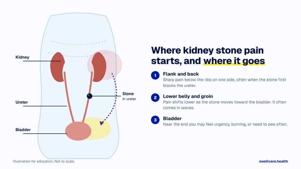 kidney stone pain location diagram